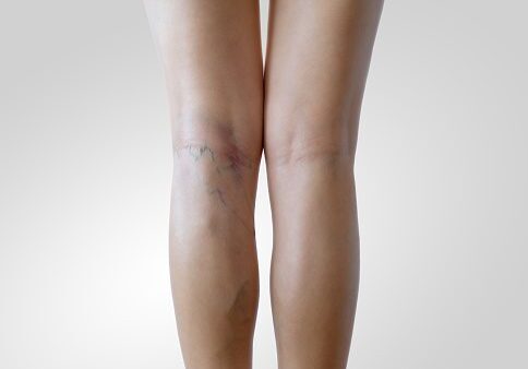 Beautiful slender woman with sign of varicose veins symptoms on a legs. Leg pain. Phlebology. Venous pathologies of the lower extremities. White background with copy space.